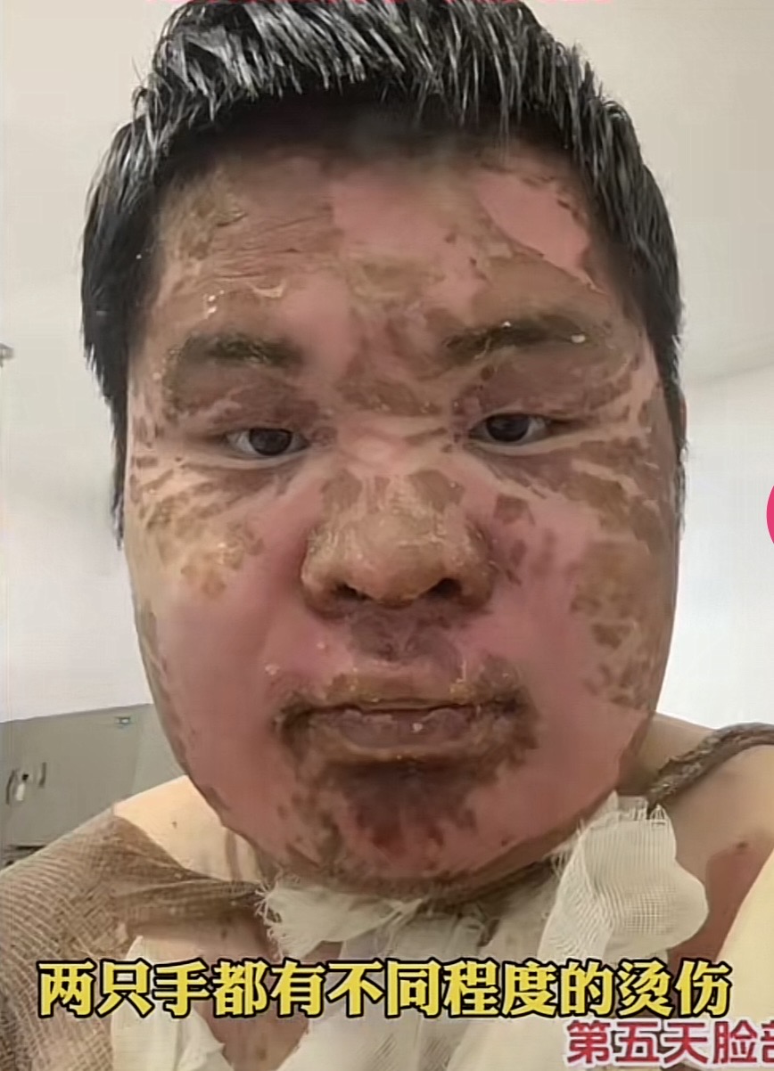 燙傷圖片2
